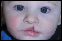 cleft-palate-baby