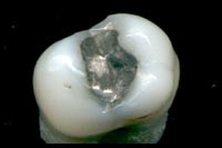 Causes of Dental Mercury Amalgam Failure