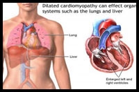 Mercury induced idiopathic dilated cardiomyopathy