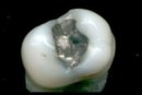 Newly placed high copper amalgam fillings release 189% more mercury than non-high copper amalgams